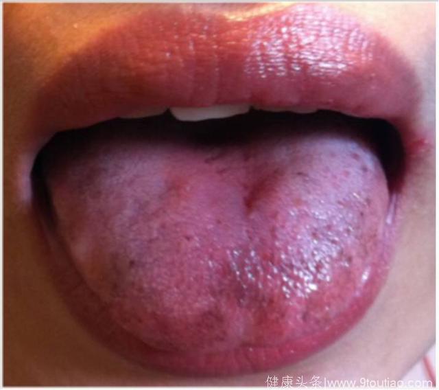 10秒测试：伸出舌头，就能看出你的心脑血管问题！