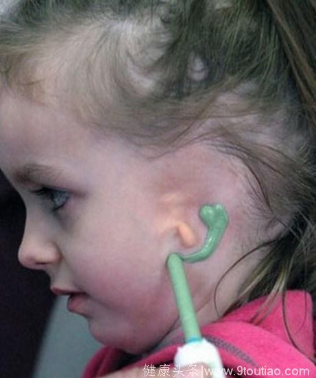 小女孩出生没有耳朵非常自卑，医生了解后制作人工耳朵