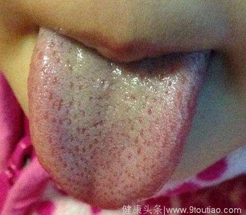 舌头出现这种颜色，那就是湿气太重，不调理一年老5岁！