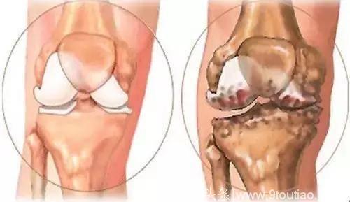 中山大学骨科专家说：膝盖疼痛与血型有关！原来这种血型的人更容易膝盖疼！
