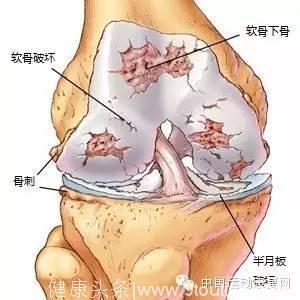 中山大学骨科专家说：膝盖疼痛与血型有关！原来这种血型的人更容易膝盖疼！