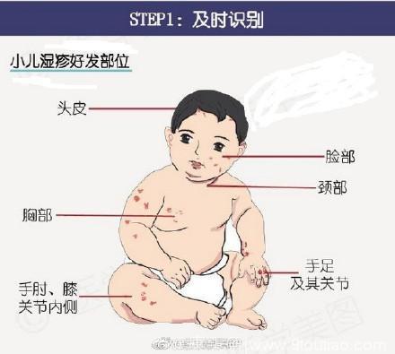 7张图让你快速了解小儿湿疹，应对宝宝湿疹有妙招