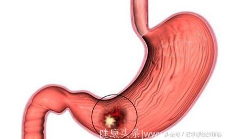 胃里出现这四种病变一定要小心，拖久了会变成胃癌！