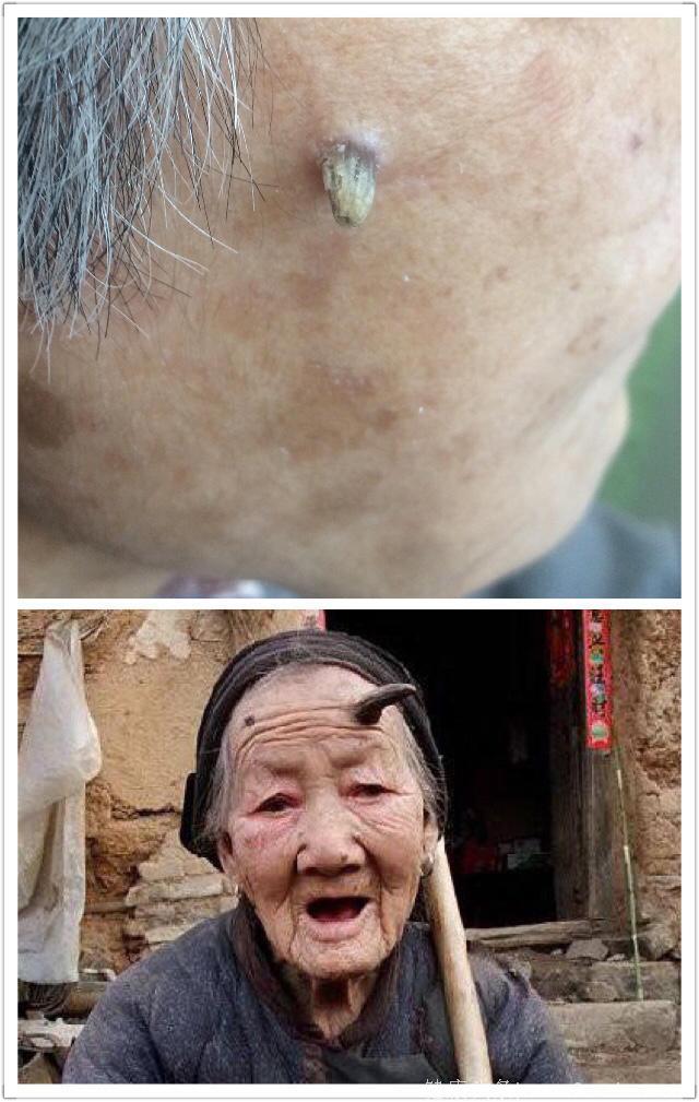 长在老人脸上的这种皮肤病有恶变的可能性，必须及时给予治疗！