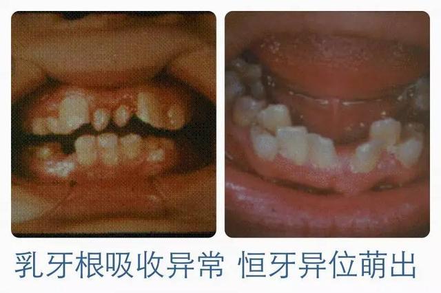 为什么乳牙拔下来后没有牙根？是医生把牙齿拔断了吗？