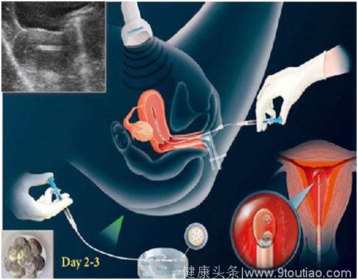 北京家恩德运医院：试管婴儿胚胎移植过程全解析