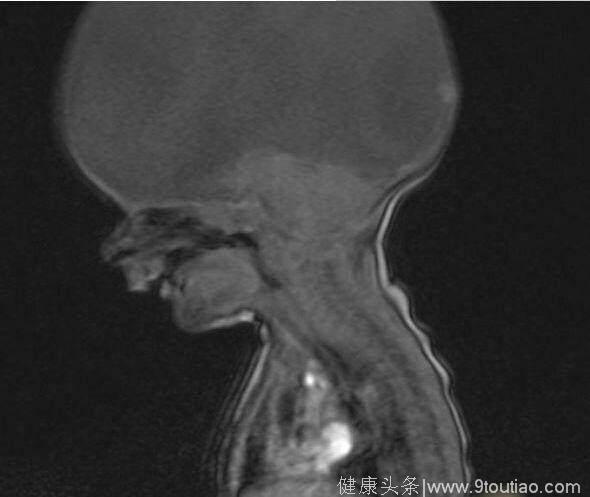 孕期细节没注意，导致可爱宝宝出生没有大脑，让人感到心疼和惋惜