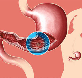 胃间质瘤晚期远处转移，有什么典型症状？
