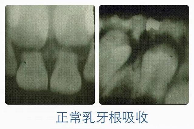 掉落的乳牙牙根不完整，这是正常的吗？