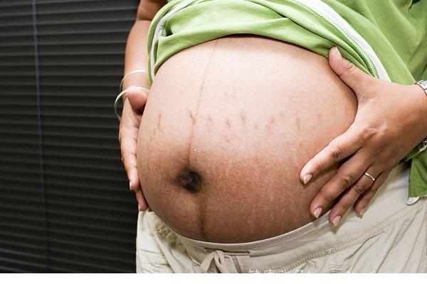 你的孕期也出现妊娠纹了吗？这些方法帮你预防