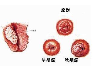 医生告诫：这4种女性的宫颈炎，易“恶化”为宫颈癌，早发现能救命！