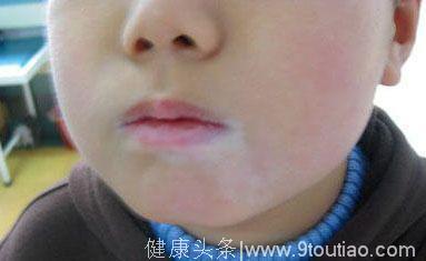 郑州华夏：儿童白斑危害多？家长带着做护理？