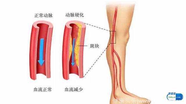 警惕血栓堵死心脏！腿脚有这4个表现，说明你的血管堵住了