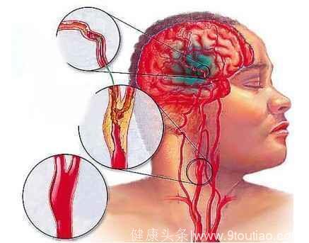 脑溢血来临前有7个征兆，9个方面来预防，早知道可保命！