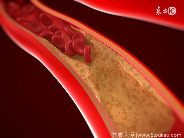 改善动脉硬化从吃水果开始