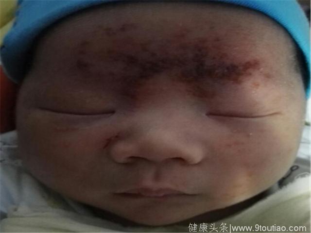 儿童湿疹的克星，农村一种药方，有效帮宝宝恢复