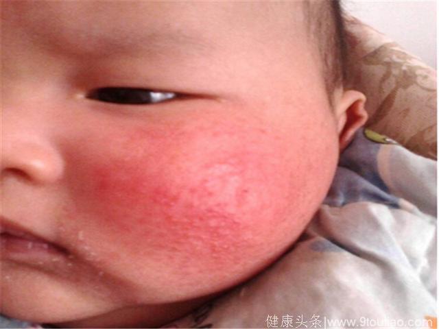 儿童湿疹的克星，农村一种药方，有效帮宝宝恢复