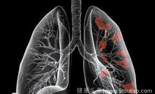 肺癌能治好吗？