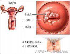 肿瘤专家告诫：注意这四点，女人不易患宫颈癌！