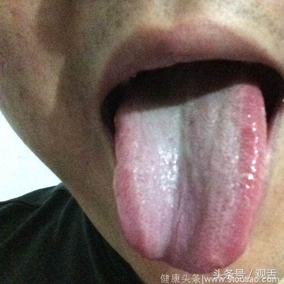 舌诊：胃虚湿寒、脾肾阳虚、肝脾不和、肝亢克脾的舌照！