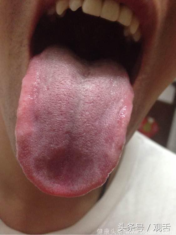 舌诊：胃虚湿寒、脾肾阳虚、肝脾不和、肝亢克脾的舌照！