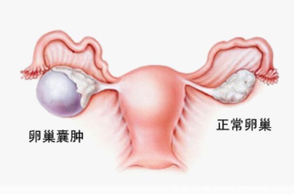 有卵巢囊肿的女性，可以试一试的保守疗法