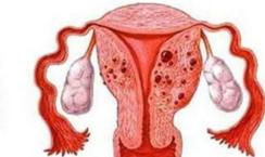 子宫囊肿是如何影响女性怀孕的