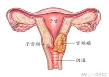医生告诫女性：这四类食物，容易引发宫颈癌！