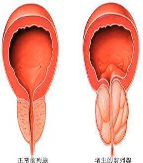 前列腺增生如何预防