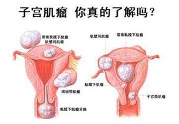 这几种子宫肌瘤症状情况容易导致流产