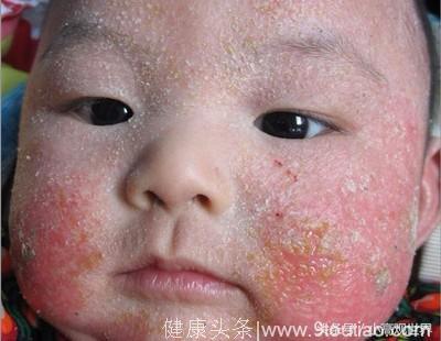宝宝为什么会得湿疹？有了湿疹应该吃什么？知道这些就够了！