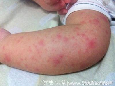 宝宝为什么会得湿疹？有了湿疹应该吃什么？知道这些就够了！