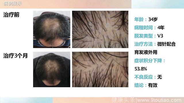 微针配合域发治疗雄激素性脱发的病例分享