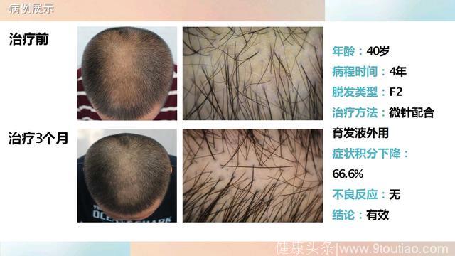 微针配合域发治疗雄激素性脱发的病例分享
