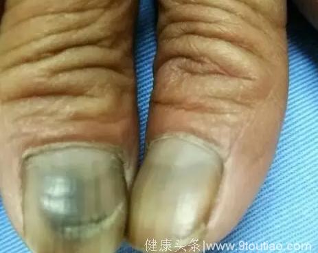 血液病人长期服用羟基脲导致指甲发黑