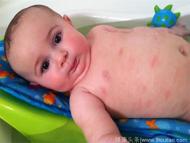 儿童湿疹顽固治不好，一种野生草，轻松治愈宝宝湿疹