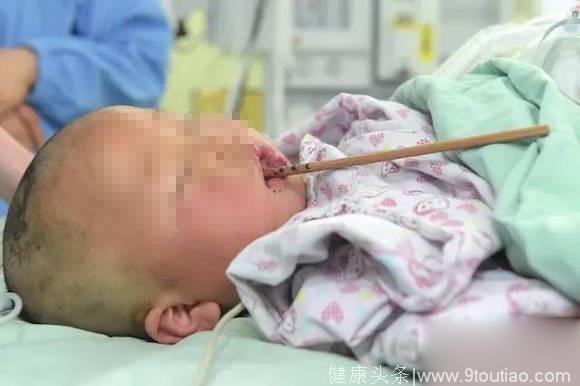 1岁宝宝被筷子穿透上颚，妈妈怪外婆照顾不周