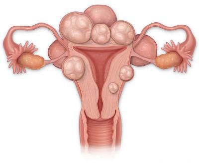 子宫肌瘤变恶性的几率有多大？如何预防？