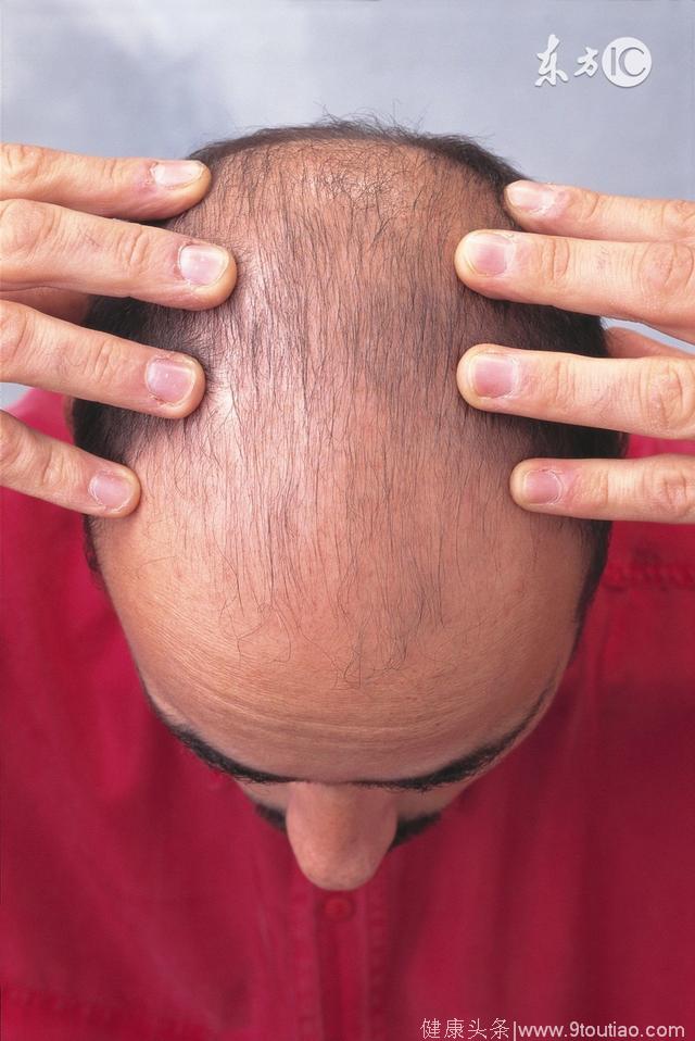 88%的脱发人士头皮内长有头螨——恐怖：脱发人头上可能爬着几万只虫子