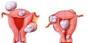 如何对子宫肉瘤患者进行正确的护理