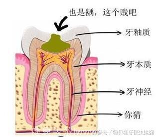 牙洞不补小洞变大 会伤神经