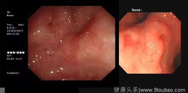 胃病不当事，67岁老人胃炎1年变胃癌，很多人胃里都有它