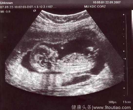 胎儿是男是女，医生的“绝妙”暗语，只有1%的准妈妈能听懂！