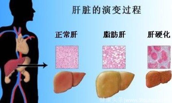 脂肪肝已成为全球第一大肝病！汤糖躺烫最易惹来脂肪肝！