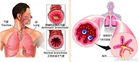 慢性支气管和咳嗽变异性哮喘的6大区别！