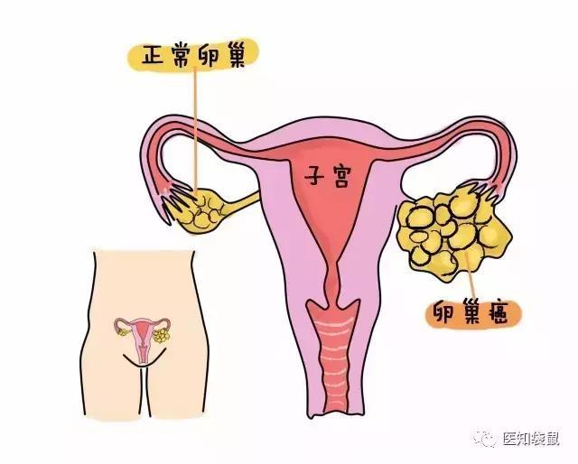 12岁女孩患卵巢癌，卵巢癌离每个女人的距离有多远？