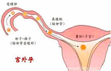 因为宫外孕切掉了一侧输卵管的人，还能正常怀孕吗？