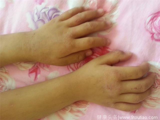 孩子患上湿疹疼痛难耐，一种食疗法，能帮助孩子去除湿疹