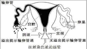 女性不孕，来测测你输卵管的通常度！