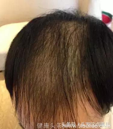 秃顶、脱发……究竟为什么脱发人群不断增加？